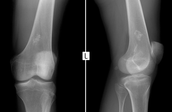 На Кубани врачи не смогли диагностировать у ребенка рак