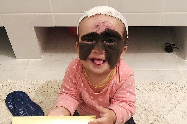 Опасная маска: Российские врачи спасают маленькую американку с огромным родимым пятном на лице Опасная маска: Российские врачи спасают маленькую американку с огромным родимым пятном на лице