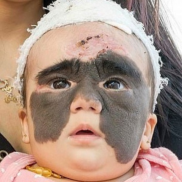 Опасная маска: Российские врачи спасают маленькую американку с огромным родимым пятном на лице Опасная маска: Российские врачи спасают маленькую американку с огромным родимым пятном на лице