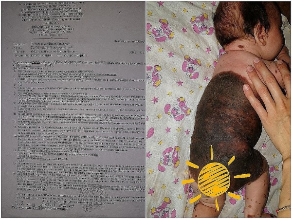 Опасная маска: Российские врачи спасают маленькую американку с огромным родимым пятном на лице Опасная маска: Российские врачи спасают маленькую американку с огромным родимым пятном на лице