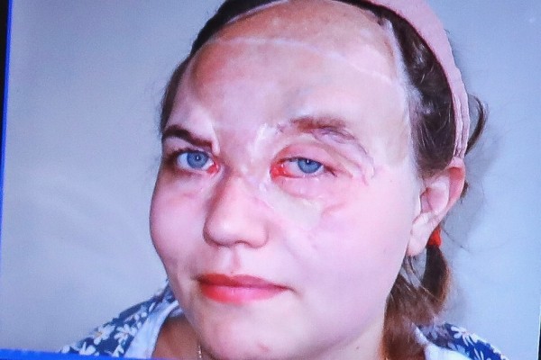 Краснодарские хирурги &laquo;собрали&raquo; лицо 18-летней крымчанки, пострадавшей в ДТП