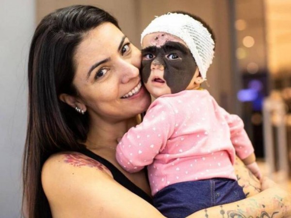 Россиянин оплатил операцию девочке из США с &laquo;маской Бэтмена&raquo;, которую лечат в Краснодаре