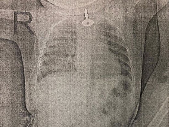 Новороссийский хирург спас 11-месячную девочку, проглотившую ключ Новороссийский хирург спас 11-месячную девочку, проглотившую ключ