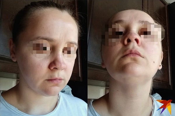 Лже-хирург Алена Верди умерла из-за «чудо-укола красоты»