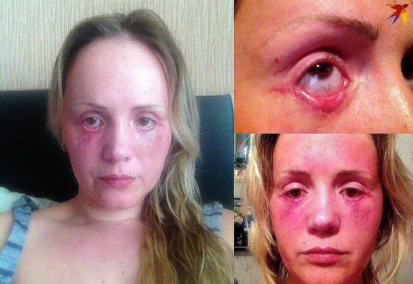 Лже-хирург Алена Верди умерла из-за «чудо-укола красоты»